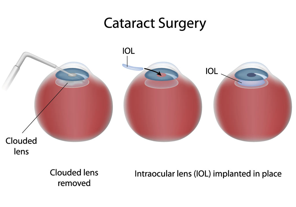 Removal of the cataract is a surgical procedure