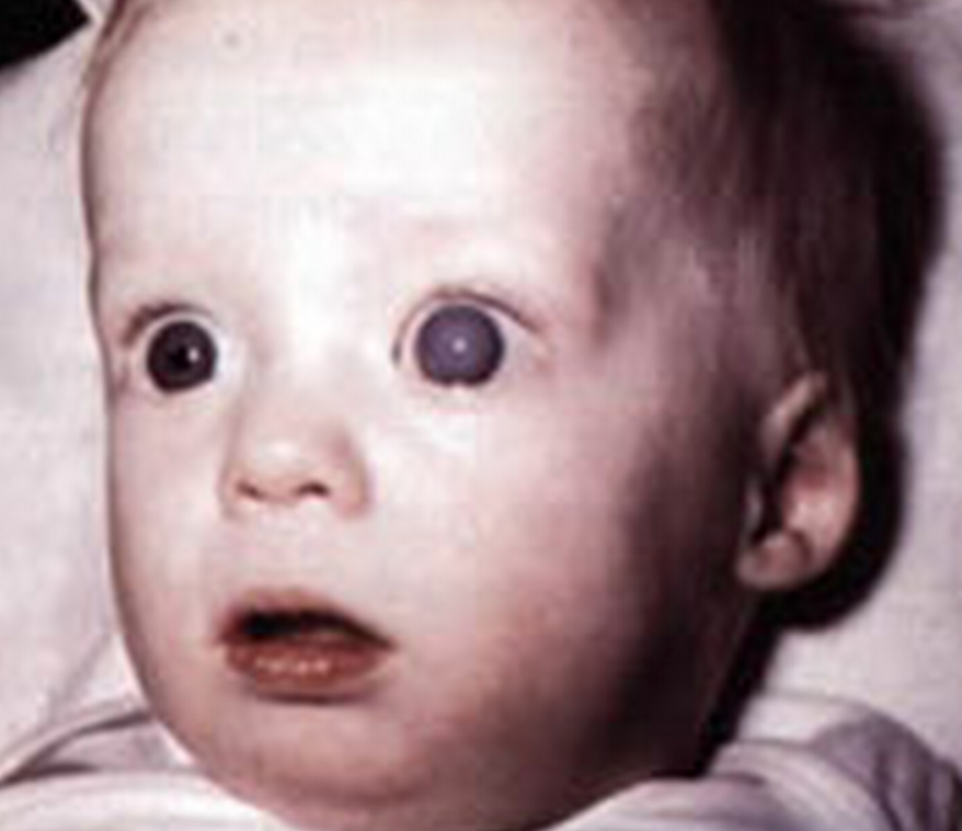 Figure 1. Buphthalmos and corneal clouding of the left eye