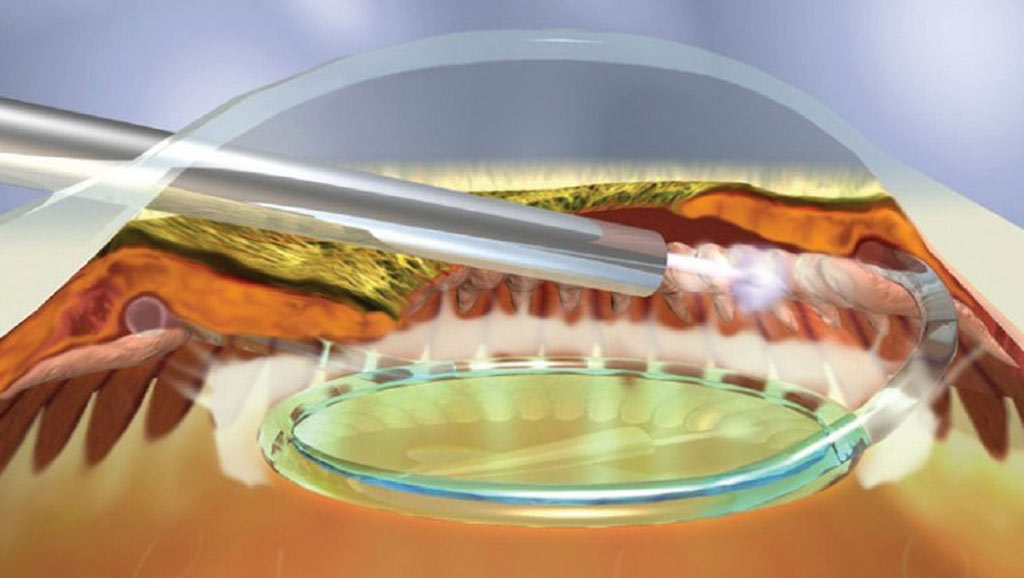 Endocyclophotocoagulation (ECP) procedure to reduce eye pressure in glaucoma