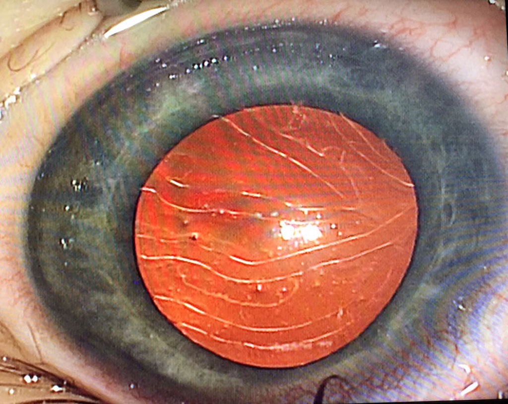 Figure 2. Haab's striae – horizontal curvilinear breaks in the cornea