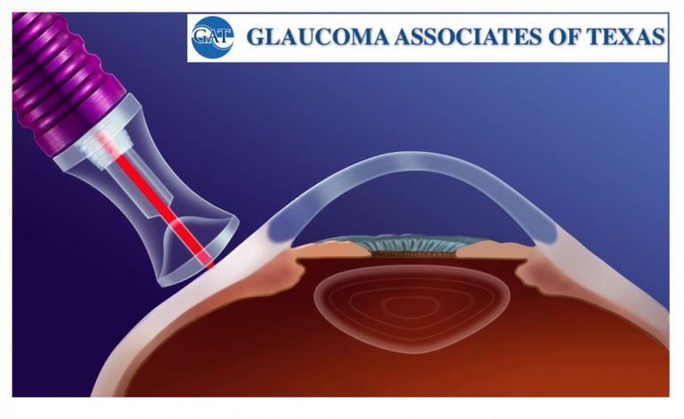 Micropulse Transscleral
Cyclophotocoagulation (MP-TSCPC)