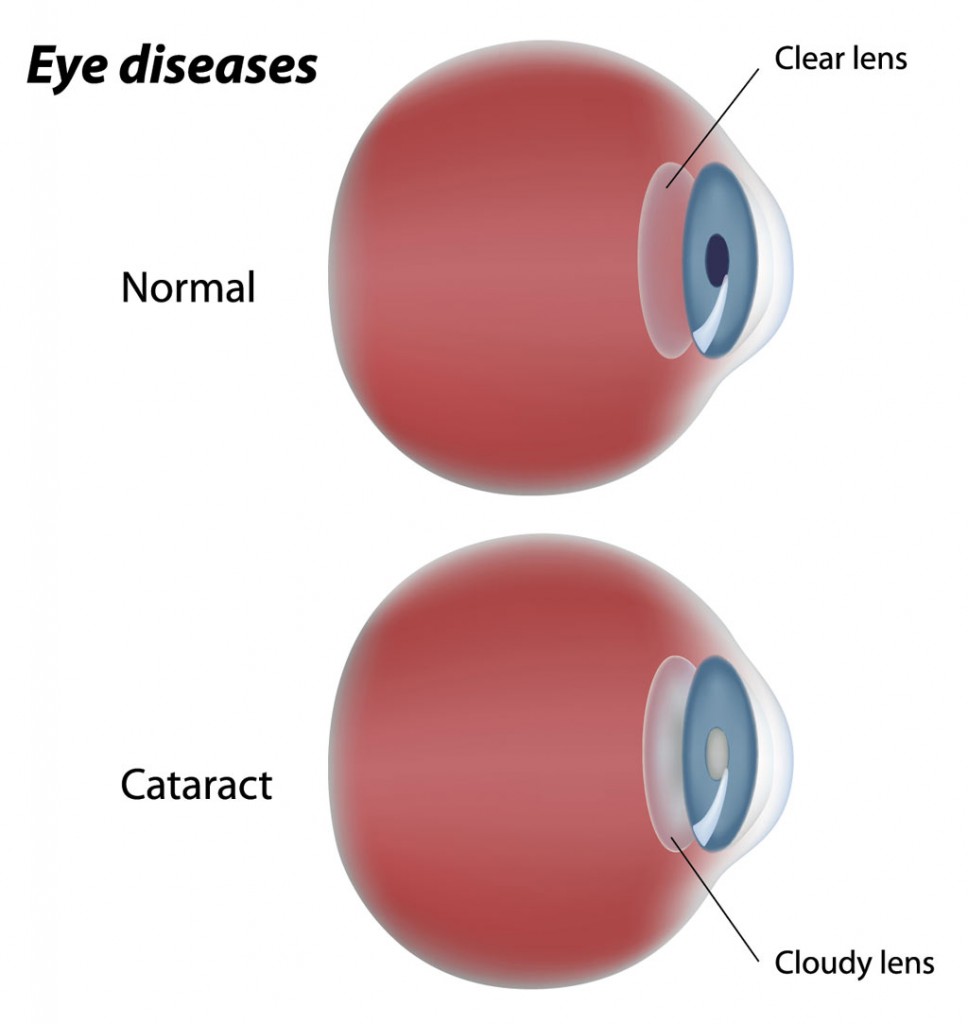 A cataract is hardening and clouding of the natural crystalline lens within your eye ball