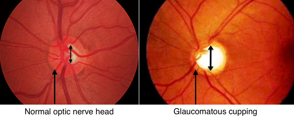 Note the normal optic nerve on the left. Compare that to the optic nerve on the right. The large white area with the arrow shows cupping, a sign of glaucomatous damage.