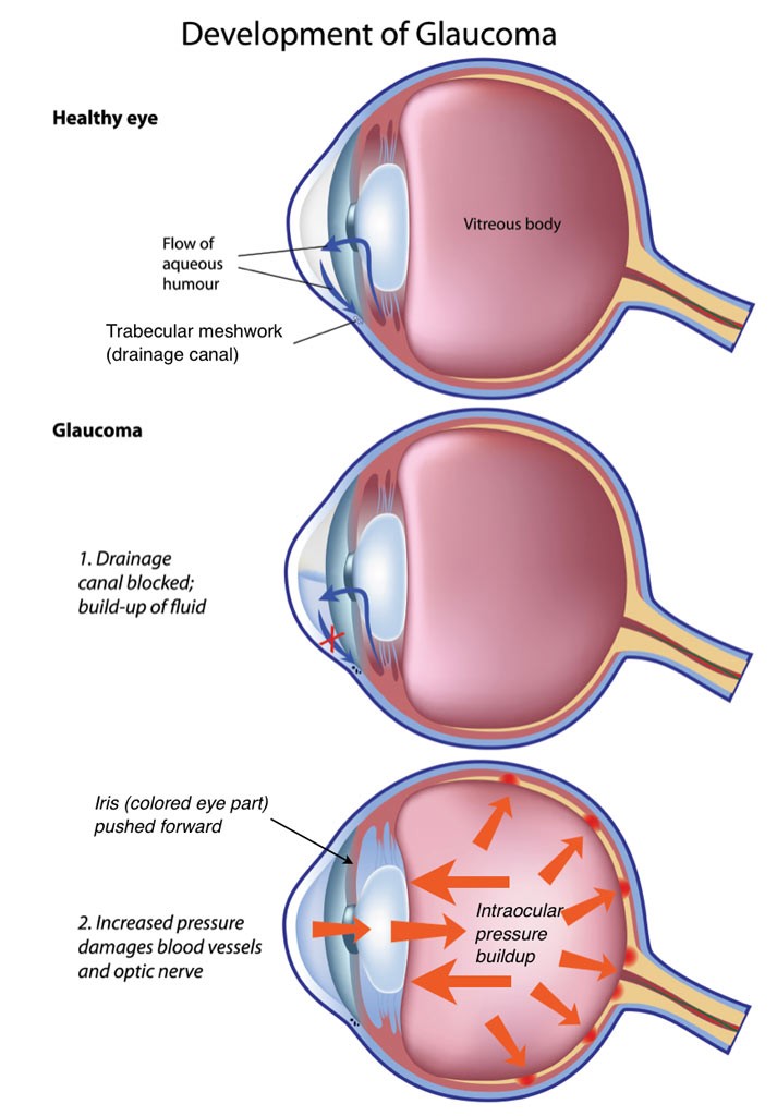 Pupillary-block glaucoma, a type of closed-angle glaucoma, the flow of fluid between the iris and lens is blocked and the pressure builds in the eye.