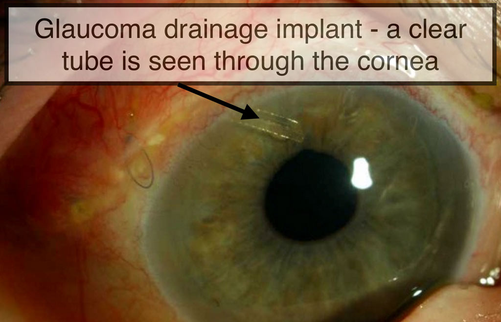 Glaucoma drainage clear tube is seen through the cornea