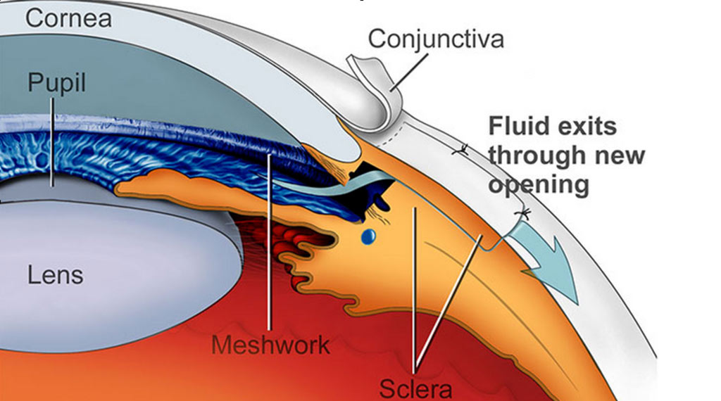 Creating a bypass channel, for fluid to flow from within the eye to pass unimpeded into the outer layers of the eye, Aqueous bypasses trabecular meshwork( the tiny drain within the eye) which is impaired in glaucoma.