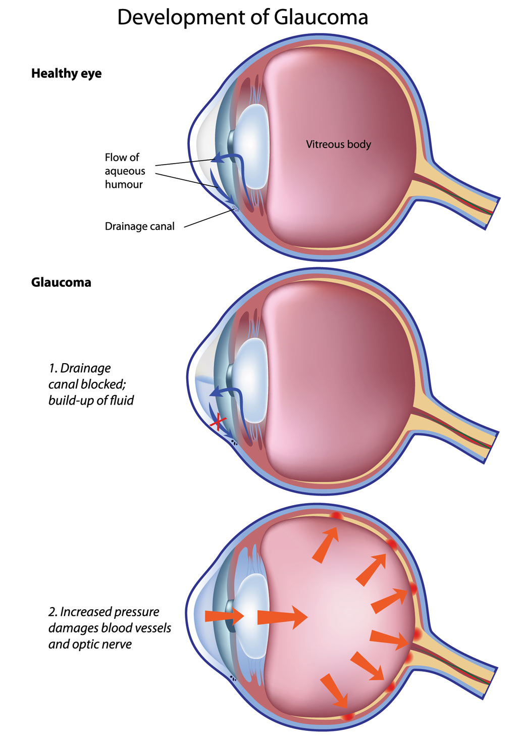 Pupillary-block glaucoma, a type of closed-angle glaucoma, the flow of fluid between the iris and lens is blocked and the pressure builds in the eye