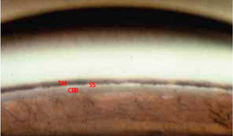 Gonioscopic view of a normal anterior chamber angle