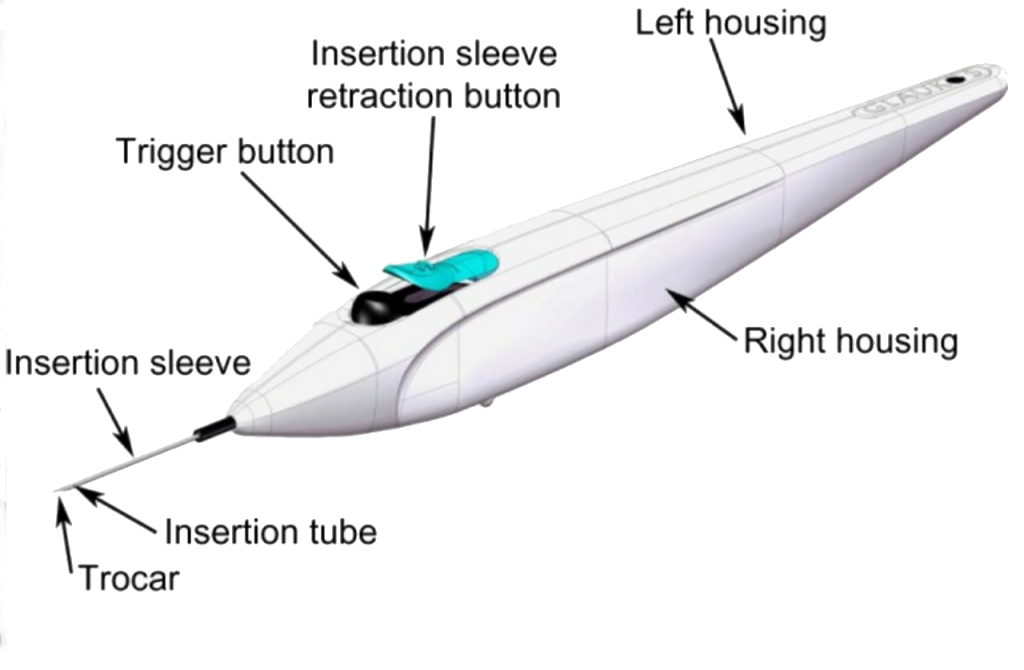 Diagram of the iStent® trabecular micro-bypass device used to treat mild to moderate open-angle glaucoma