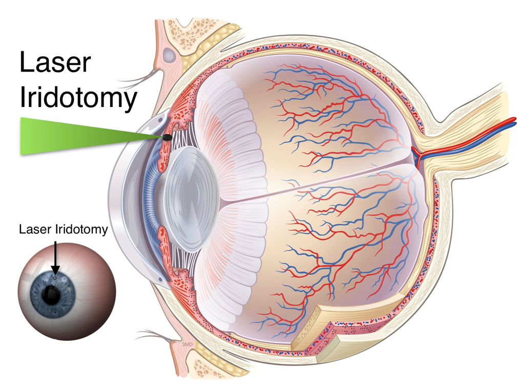 The hole in the iris is known as an iridotomy