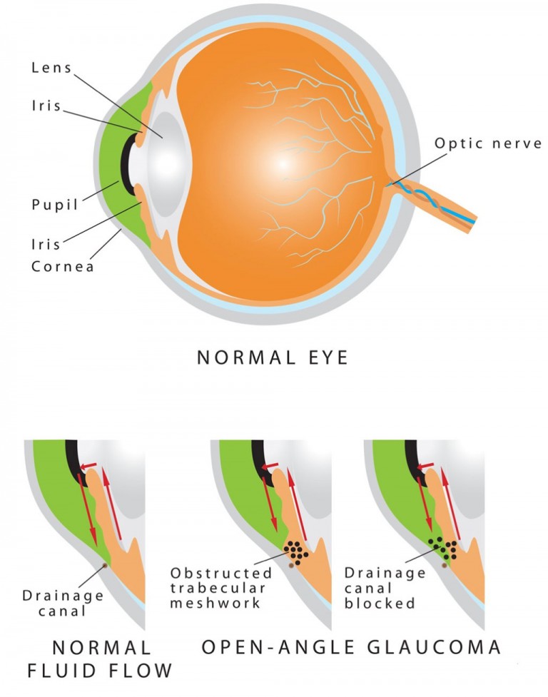 Primary Open-Angle Glaucoma