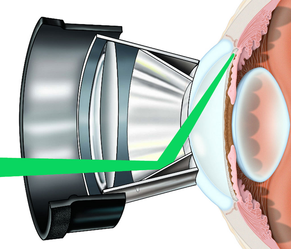 Selective Laser Trabeculoplasty (SLT) is a new procedure performed to lower intraocular pressure (IOP)