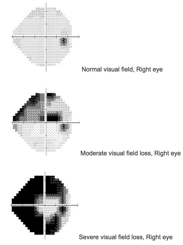 Progression of visual field loss in glaucoma from normal to moderate and severe stages
