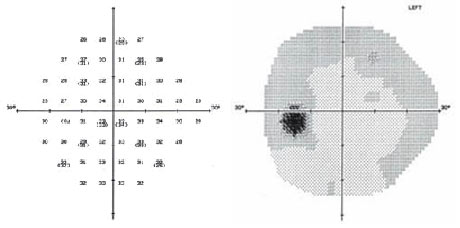 Visual Field in a Healthy Eye