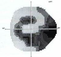 Visual Field Examination