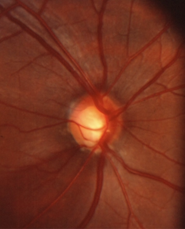 Moderate optic nerve glaucomatous damage