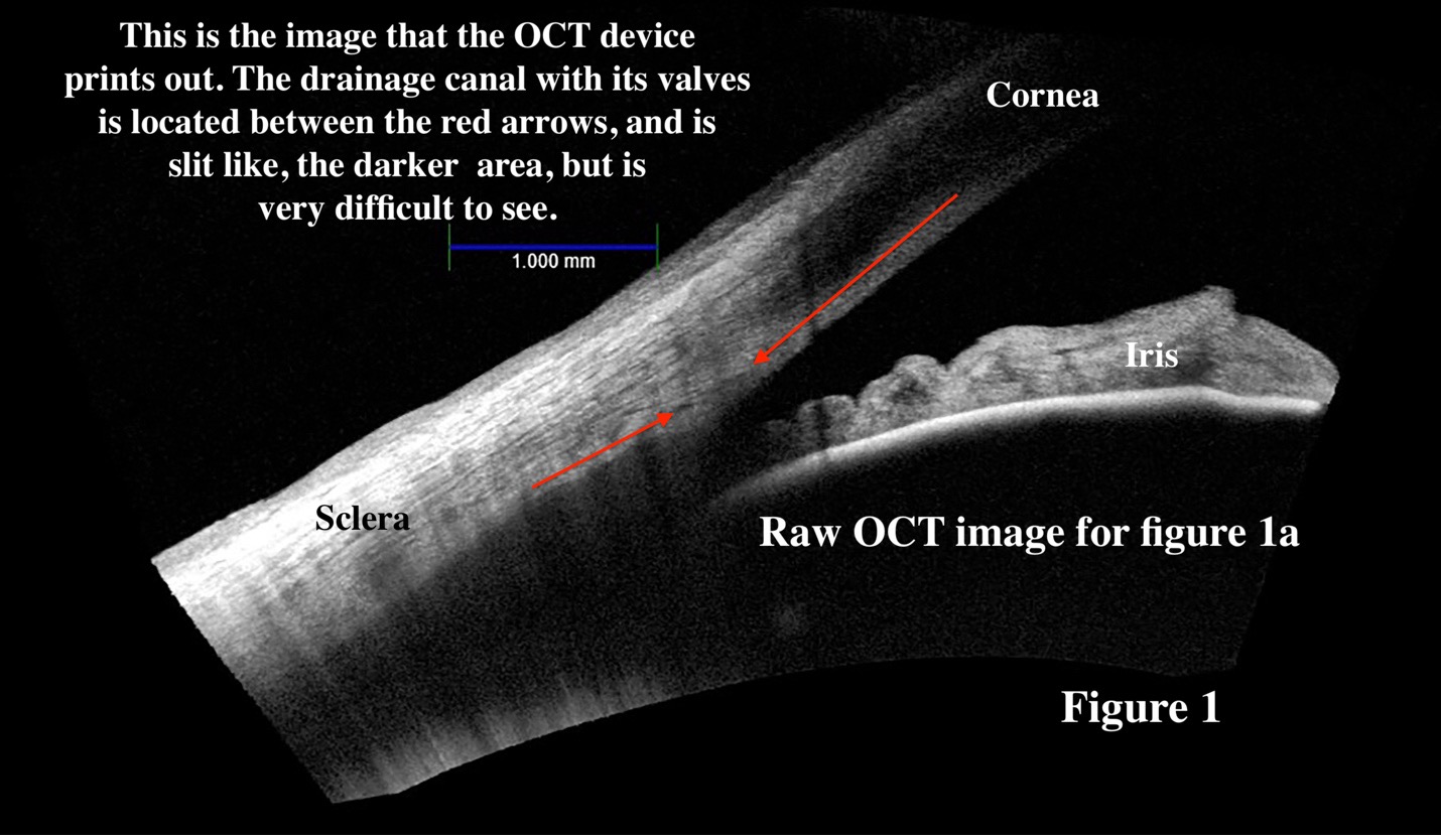 OCT image showing valve-like structures in the eye’s drainage canal