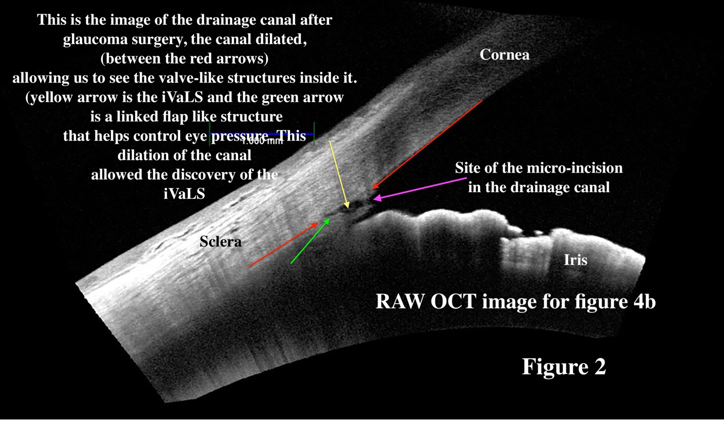 OCT image showing iVaLS valve-like structures in the eye’s drainage canal after glaucoma surgery